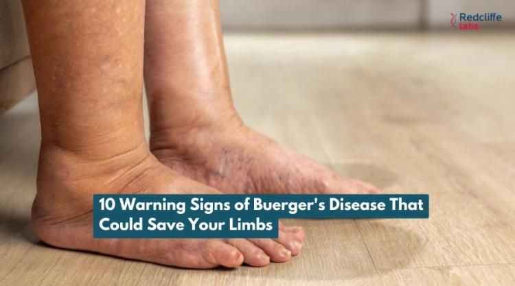 10 Warning Signs of Buerger's Disease That Could Save Your Limbs