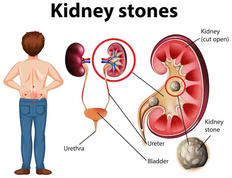 Kidney Stones Rising Among Gen Z and Millennials: How Lifestyle Shifts Can Help?