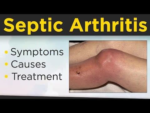 What is Septic Arthritis?Septic Arthritis Symptoms, Causes, Risk Factors And Treatment