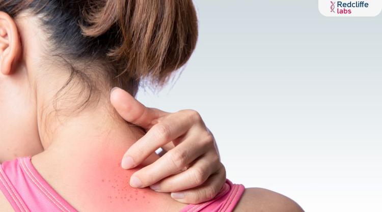 Common Skin Allergens And Their Potential Link To Skin Cancer Risk