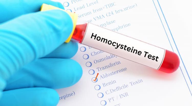 Homocysteine Test in Hindi: होमोसिस्टीन टेस्ट क्या है, कैसे, और, क्यों करते हैं
