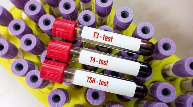 Understanding the Significance of Total T3, Total T4 & TSH Ultra-Sensitive in Thyroid Profile Testing