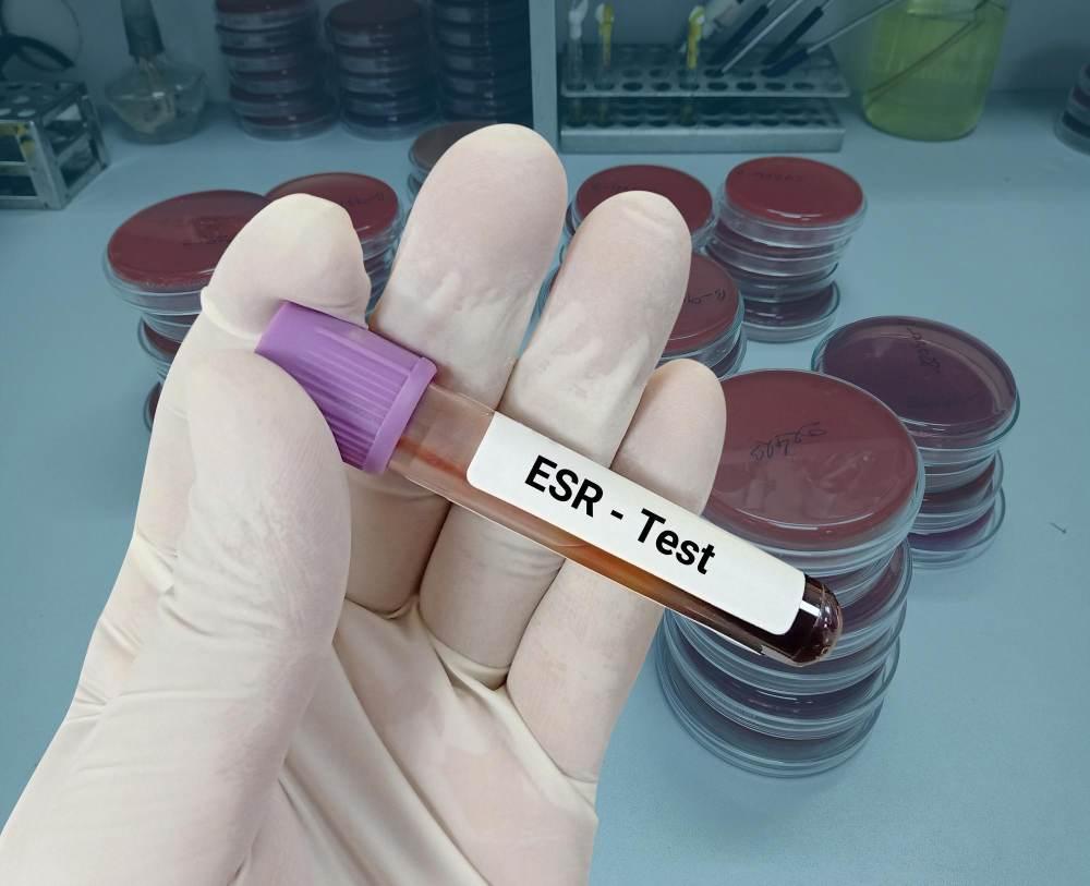 ESR Test esr-test