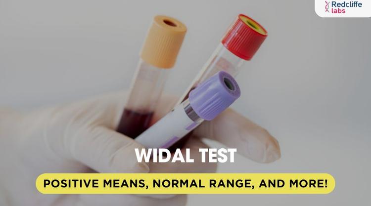 Widal Test Positive Means, Normal Range, and More!