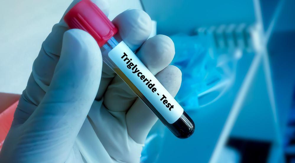 Triglycerides Lab Test Triglycerides Test