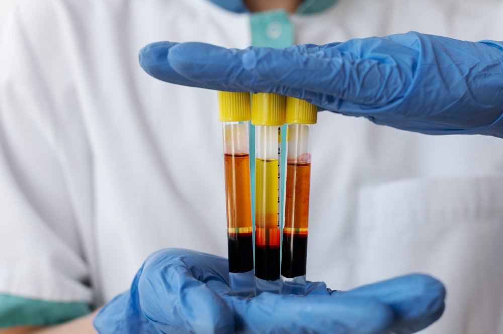 What level of GGT is dangerous? Decoding GGT Levels