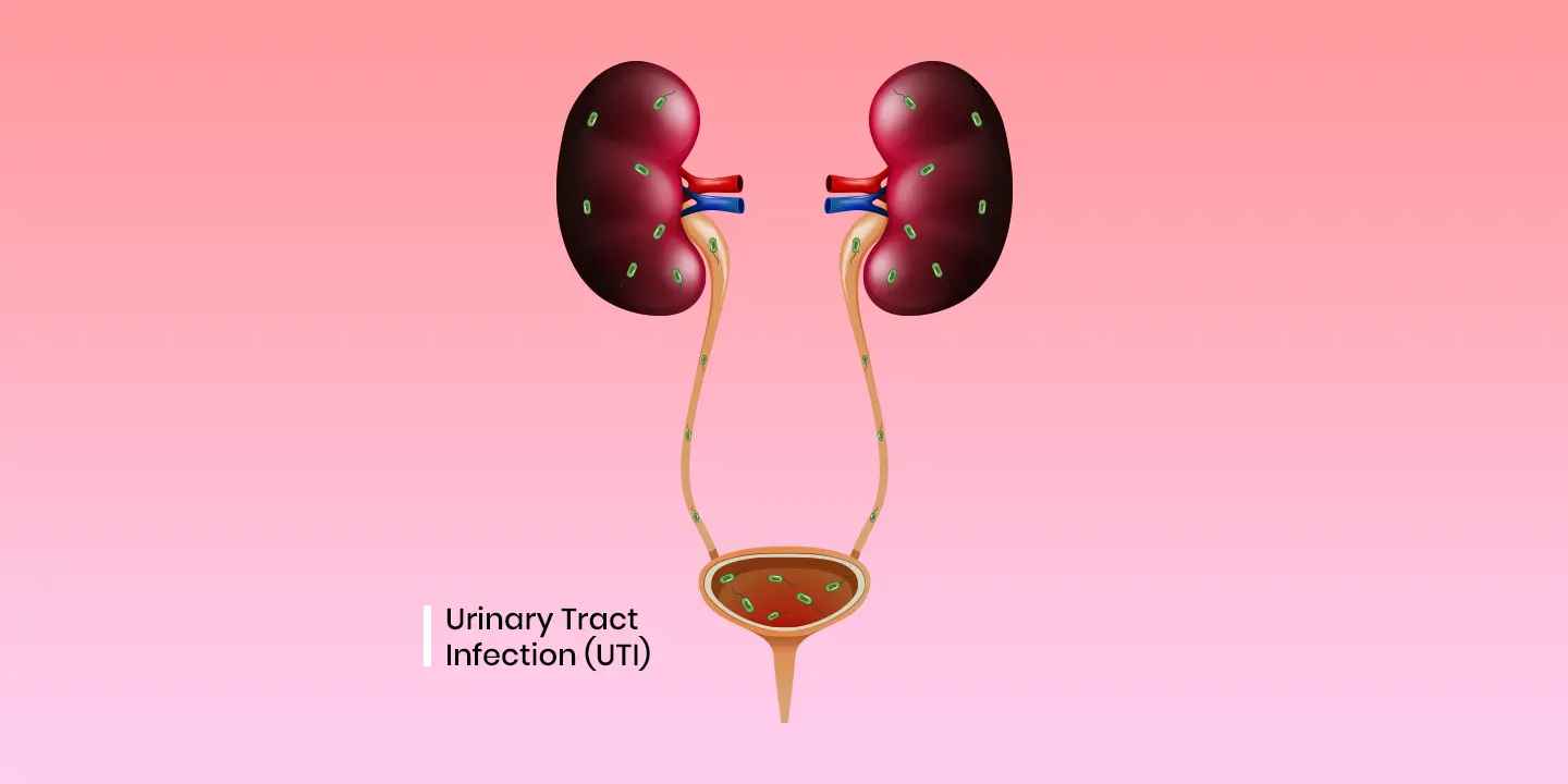 Urinary Tract Infection (UTI): Symptoms, Causes, and Treatment