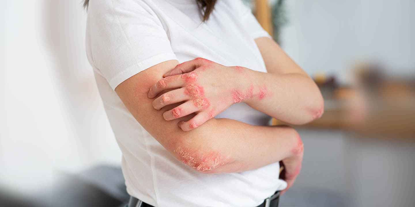 Fungal infections of the skin: symptoms, causes, and treatment