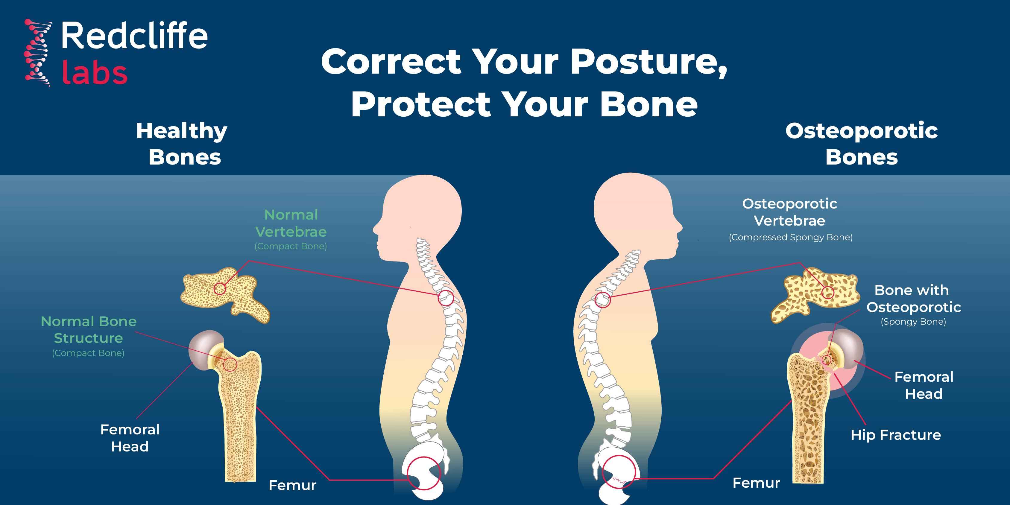 Osteoporosis Is A Silent Disease - Find Early To Fight With It