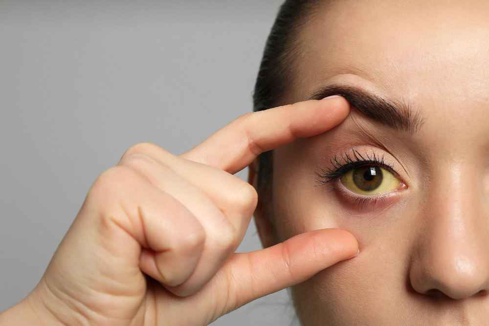 Piliya ke Lakshan: Jaundice Symptoms in Hindi, कारण व उपचार