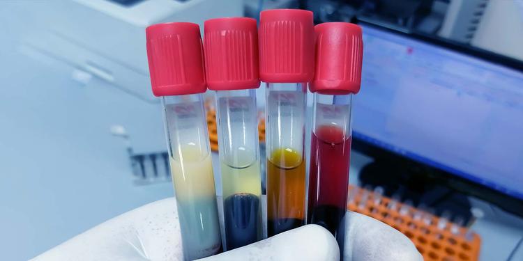 Bilirubin Test: Direct vs Indirect, Normal Range Values