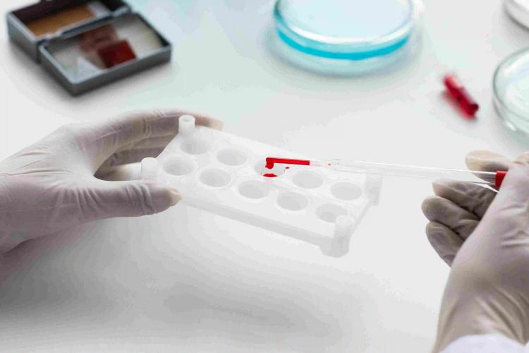 High Bilirubin Levels (Hyperbilirubinemia): Symptoms, Causes, Tests, and Treatments