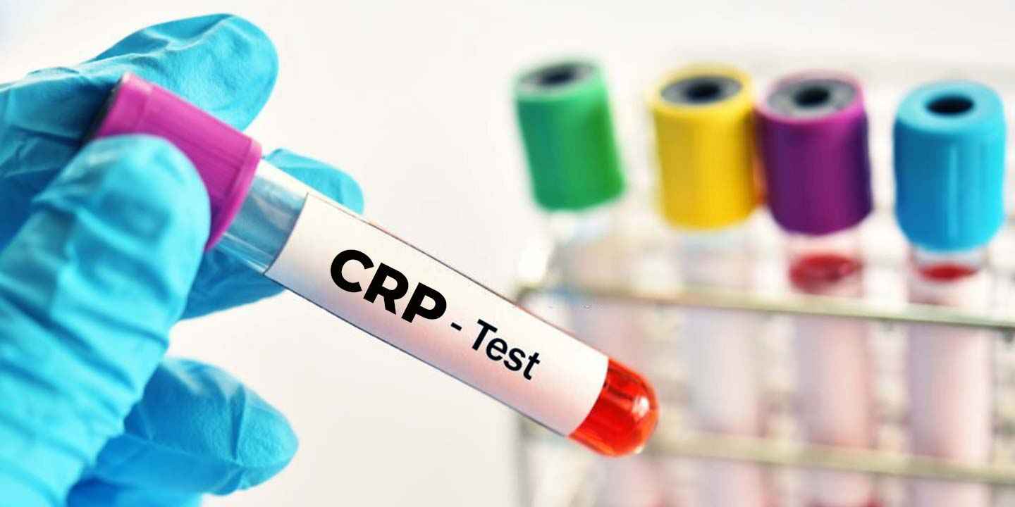 How Much CRP Level Is Dangerous? Normal vs High CRP Explained
