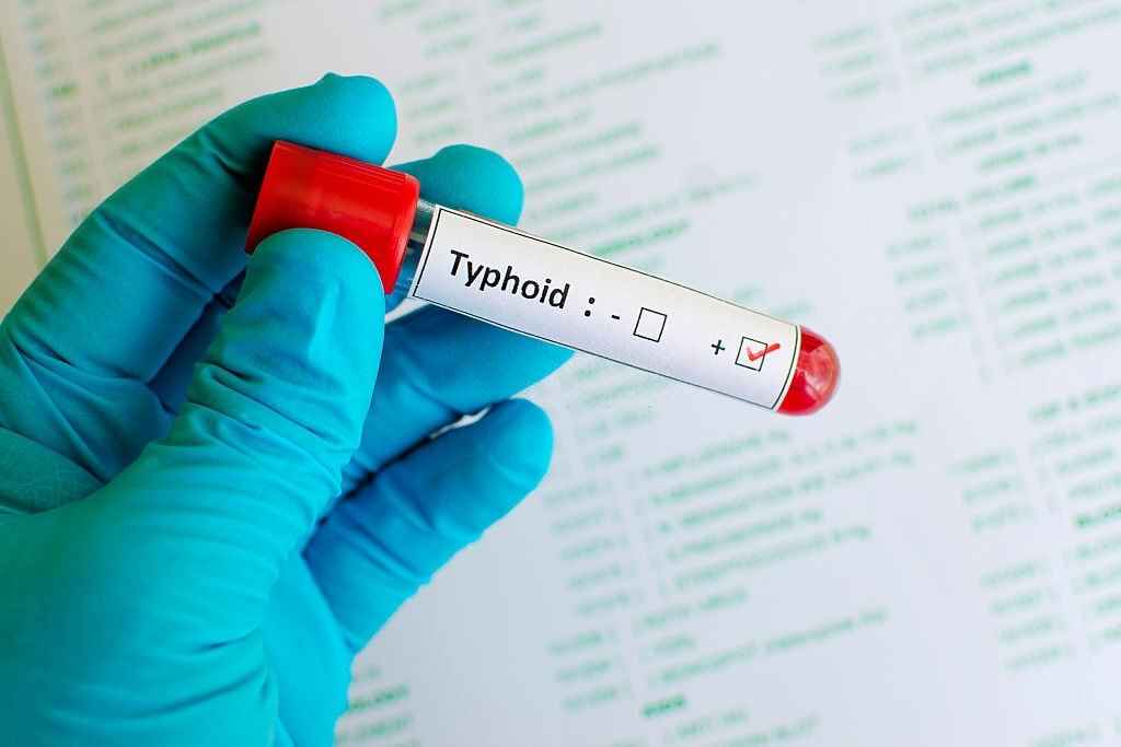 4 Stages of Typhoid Fever: Symptoms, Recovery, & Diagnosis