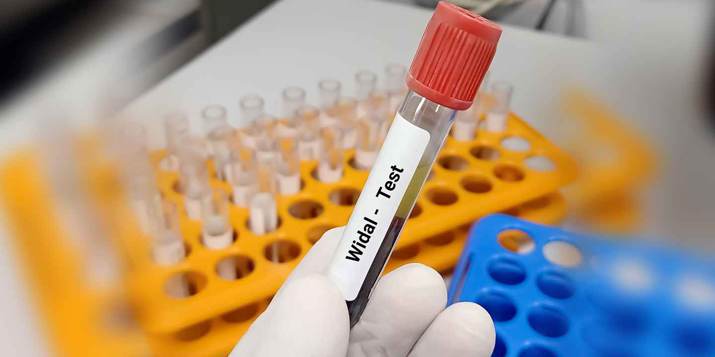 Typhoid Test Information: Price, Symptoms, Causes, Treatment