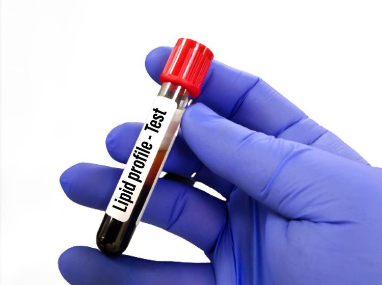 Lipid Profile Test in Marathi: आपल्या आरोग्याची देखरेख करण्यासाठी आवश्यक माहिती