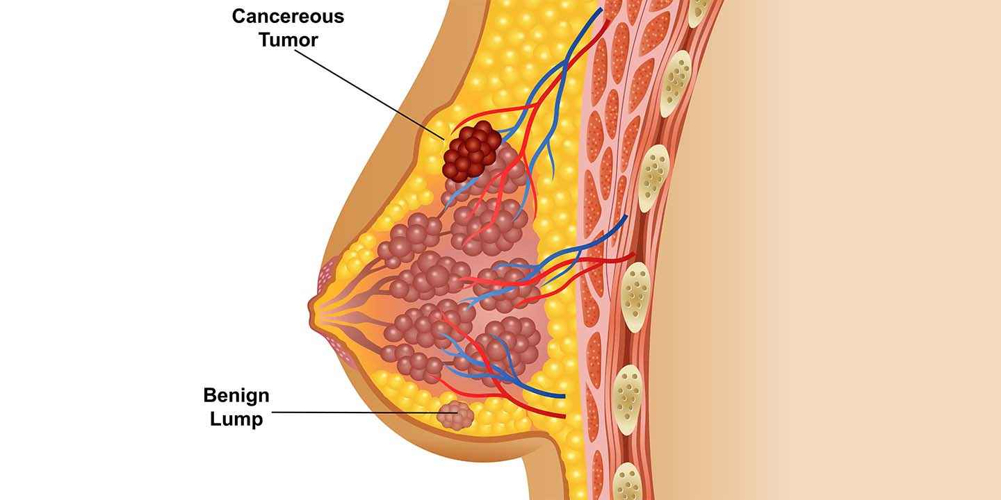 Chest Wall Tumour: Causes, Symptoms, Signs, and Treatment