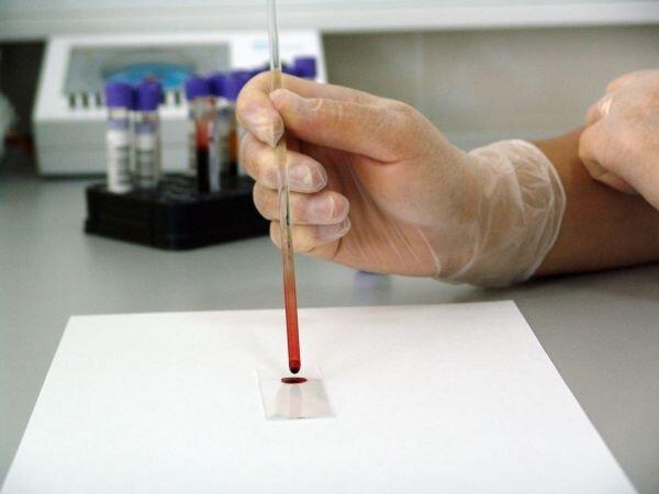 PPBS Test: Price, Procedure, Normal Range, Importance & Uses