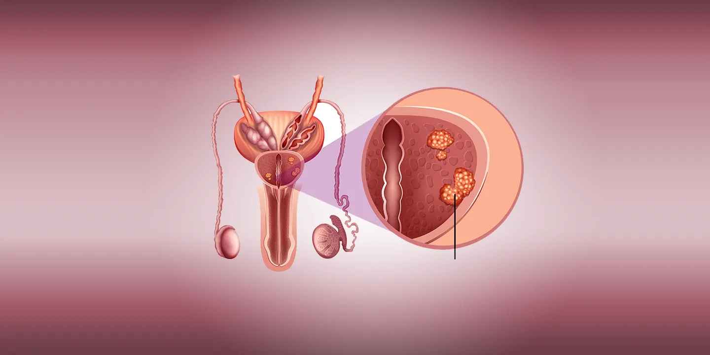 What Is Prostate Cancer: Symptoms, Causes, Tests & Treatment