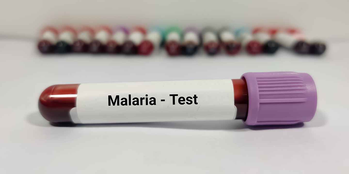 Blood Tests for Malaria: Types, Procedure & Prevention Tips