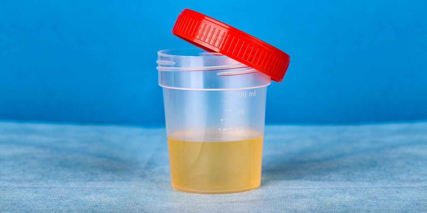 Urine Culture Test - Price, Why, When, & How its Done