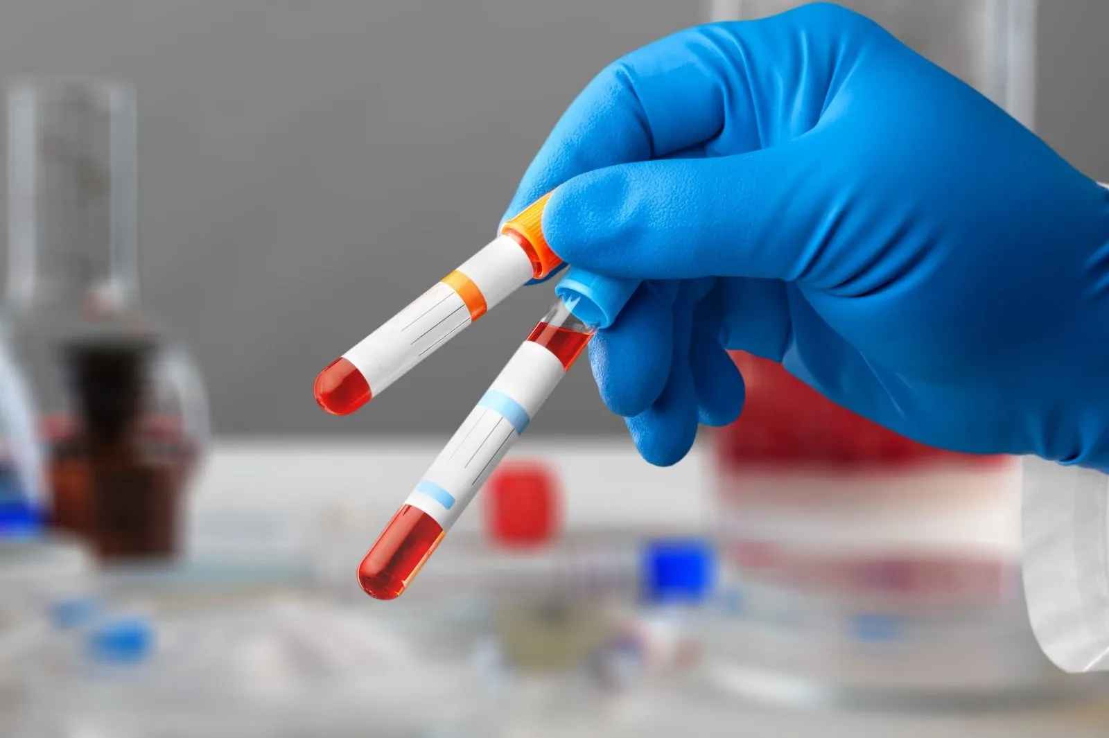All About Anemia: Types, Symptoms, Diagnosis, And More