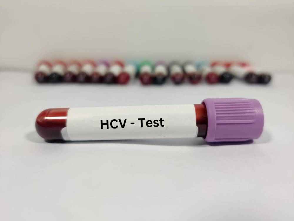 HCV Test in Hindi: हेपेटाइटिस सी वायरस की जांच और जानकारी