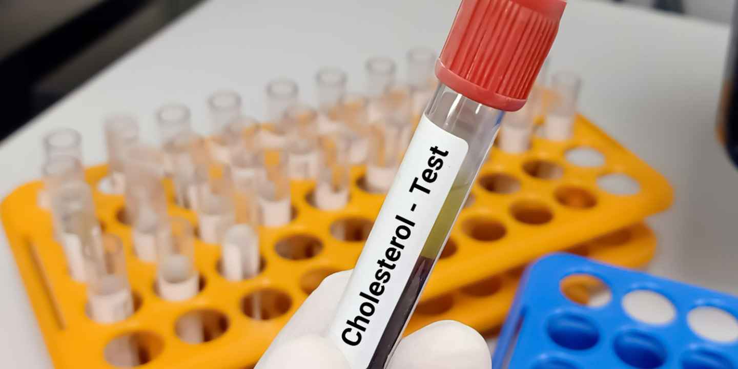 Cholesterol Test (Lipid profile) - Redcliffe labs