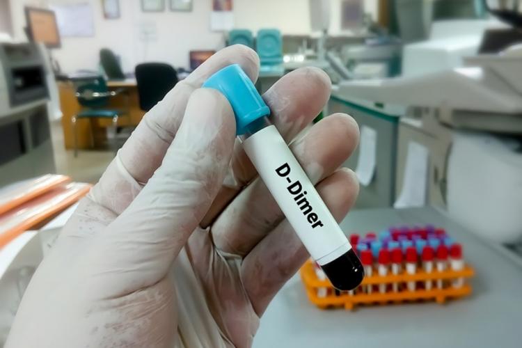 How to Reduce D-Dimer Levels In Covid 19