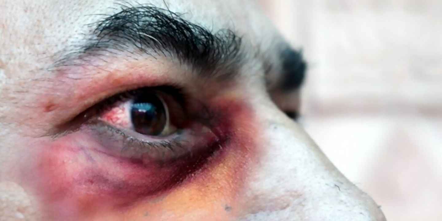 Mucormycosis or Black Fungus: Symptoms and Treatment