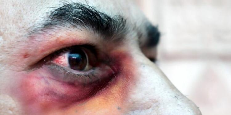 Mucormycosis or Black Fungus: Symptoms and Treatment