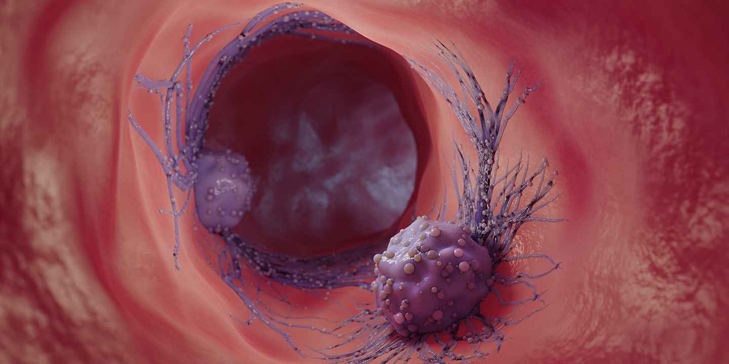New way of treating solid tumours using nanoparticles