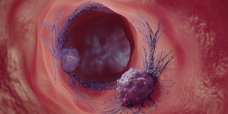 New way of treating solid tumours using nanoparticles
