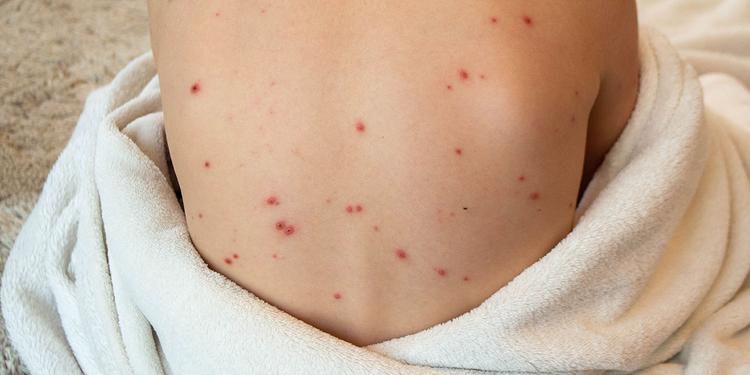 Tomato Fever: Symptoms, Causes, & Treatment