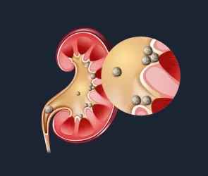 गुर्दे की पथरी (Kidney Stone): लक्षण, कारण, पथरी का इलाज और परहेज