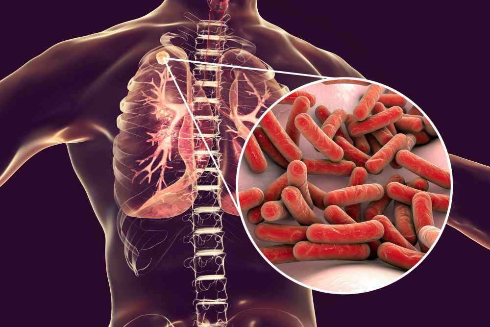 GeneXpert Test: A Game Changer in Detecting Tuberculosis