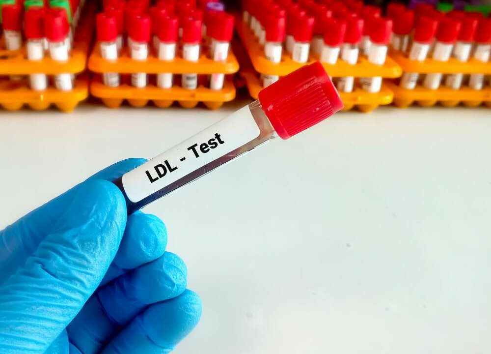 LDL Cholesterol in Hindi: समझें, नियंत्रित करें, स्वस्थ रहें
