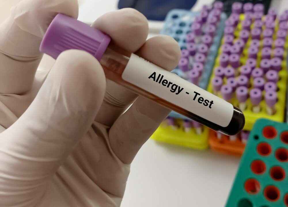 Is High IgE Levels Dangerous? Symptoms, Causes & IgE Blood Test Guide