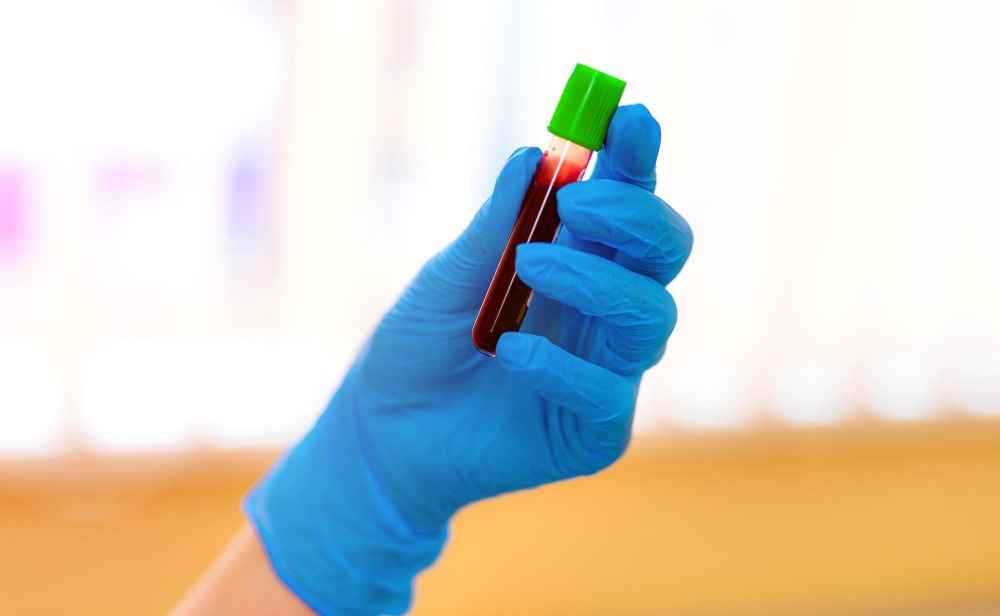 Blood Tests For Jaundice For Diagnosis And Management