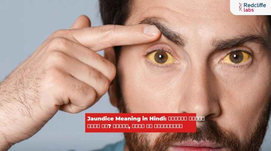 Jaundice Meaning in Hindi: पीलिया क्यों होता है? लक्षण, कारण और ट्रीटमेंट