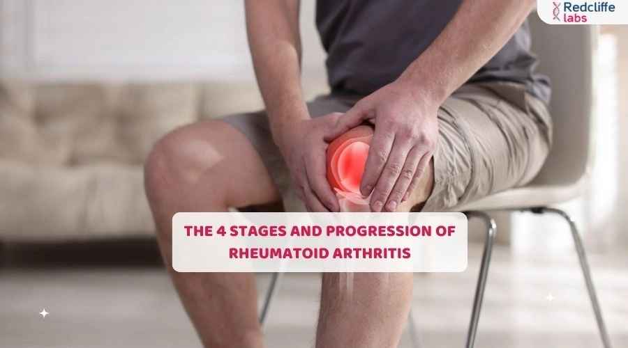 The 4 Stages and Progression of Rheumatoid Arthritis