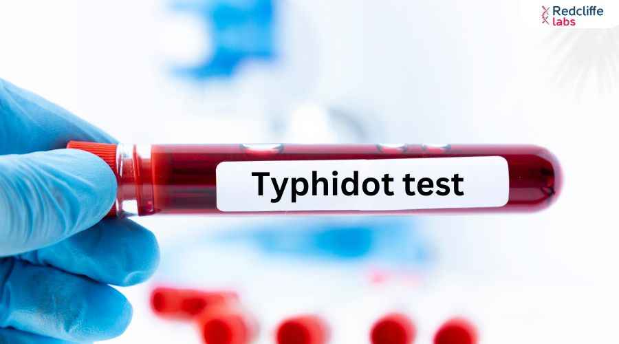 Typhidot Test - Price, Purpose, Procedure, Results, & More