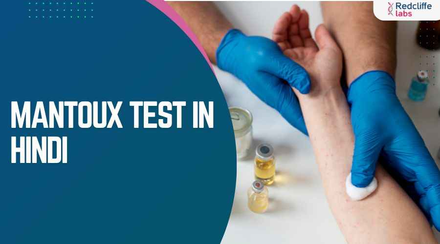 मंटू टेस्ट क्या है? (Mantoux Test in Hindi) पूरी जानकारी हिंदी में