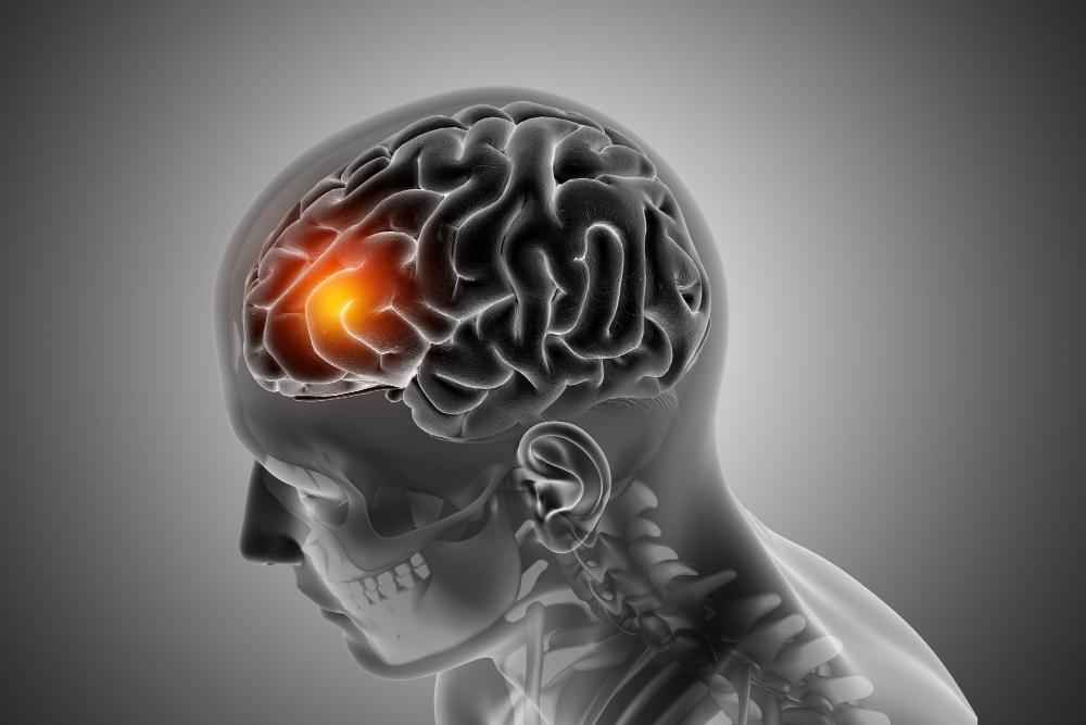 Brain Tumor Symptoms: Understanding Causes, Risks, and Signs