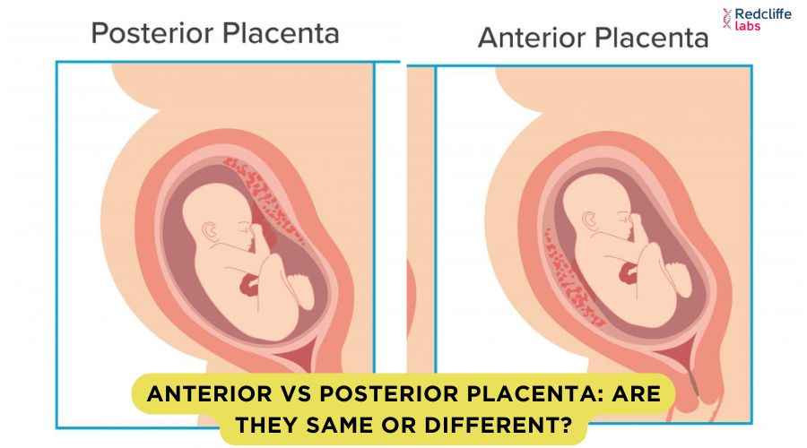 Anterior vs Posterior Placenta: Are They Same or Different?