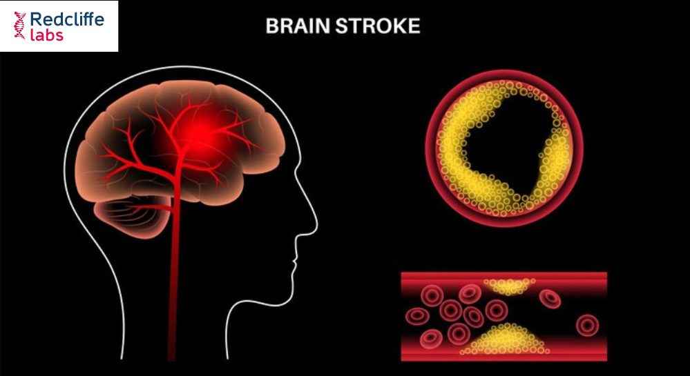 Blood Clots in the Brain: Understanding the Symptoms and Risks