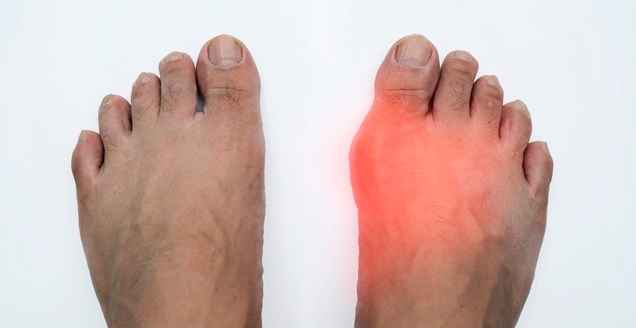 Uric Acid Treatment at Home | Natural Remedies
