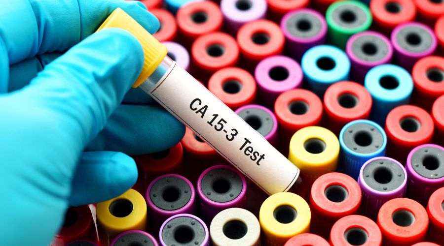 What Can Cause CA 15-3 to Rise? Check the Details