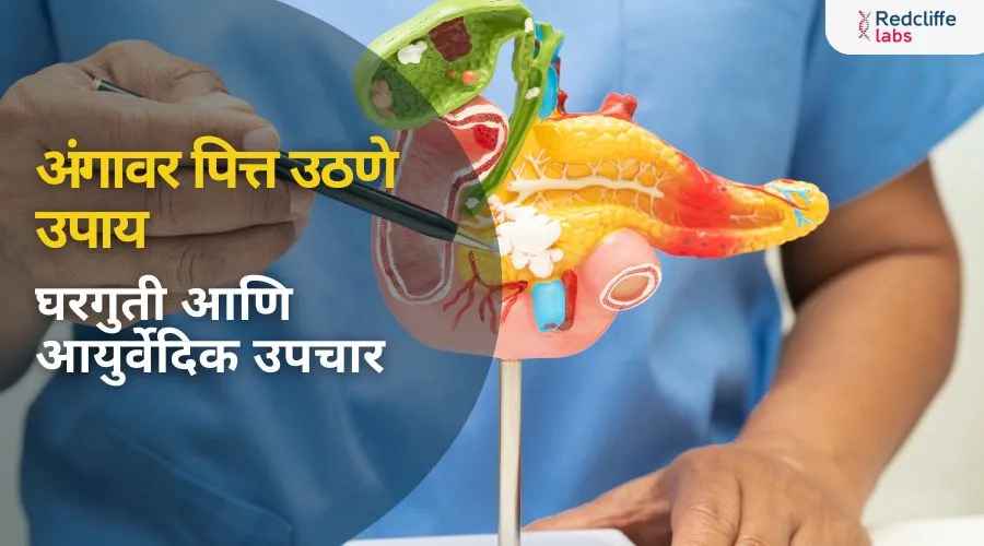 अंगावर पित्त उठणे उपाय: घरगुती आणि आयुर्वेदिक उपचार