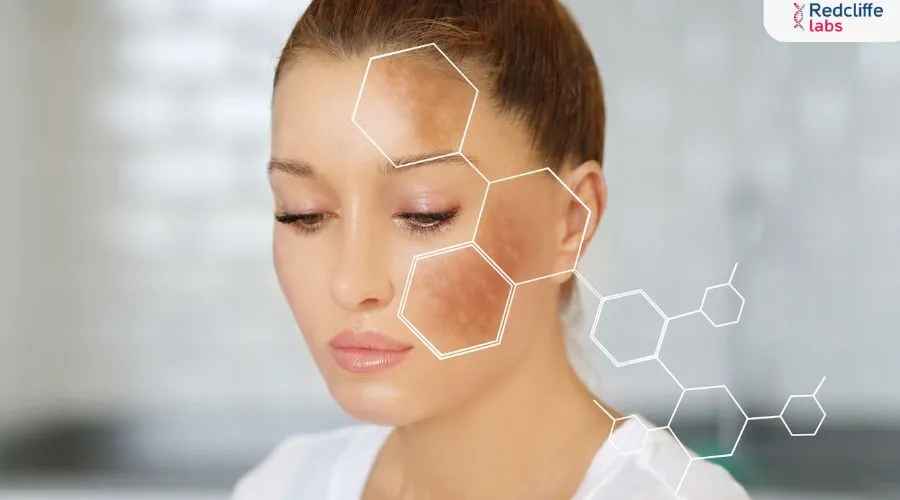 How to Reduce Melanin in the Skin?